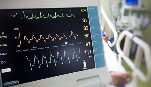 EKG monitor